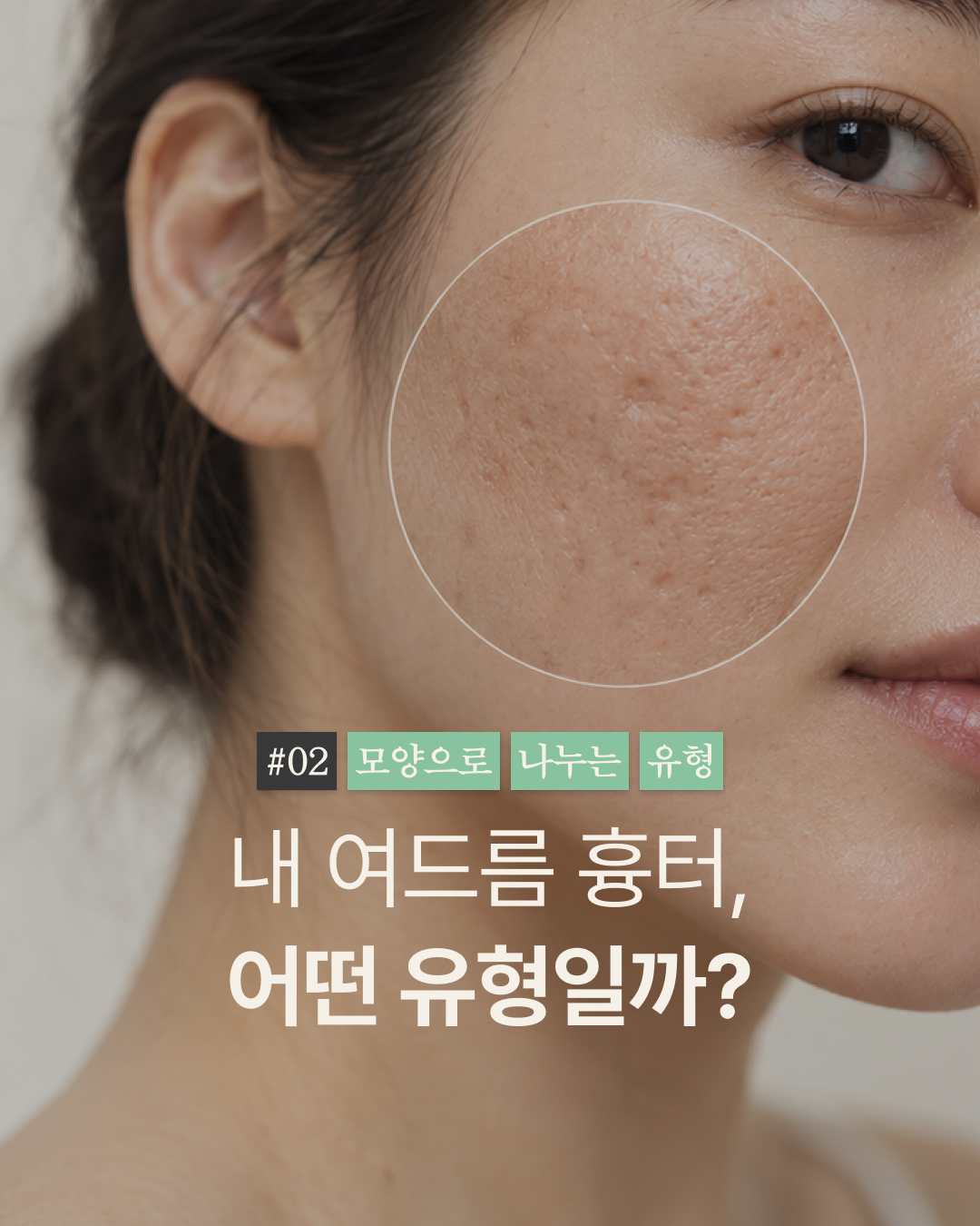 [강남점] 패인 여드름 흉터, 모양에 따라 치료 방향이 달라져요 - 해율한의원
